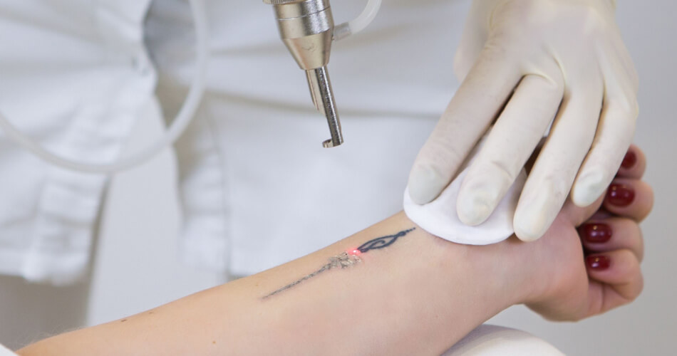 Close up of a woman getting laser tattoo removal on her wrist